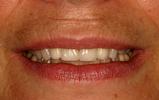 Porcelain-veneers-After-Image