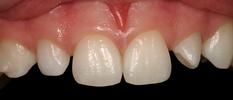 Dental-veneers-Before-Image