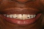 Dental-bonding-After-Image
