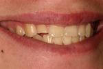 Porcelain-crowns-Before-Image