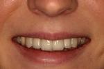Teeth-whitening-After-Image