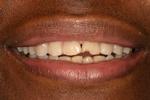 Dental-bonding-Before-Image