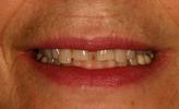 Porcelain-veneers-Before-Image