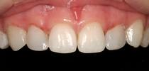 Dental-veneers-After-Image
